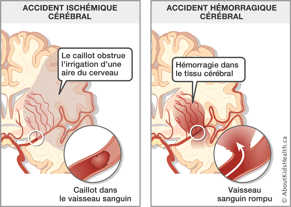 Est-ce qu&rsquo;un AVC est considéré comme un accident de travail ?